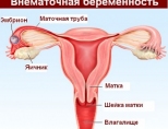 Внематочная беременность признаки и симптомы