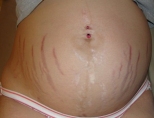 Растяжки при беременности: причины, как бороться с ними и избежать их?