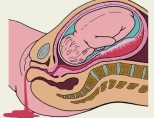 Гематома в матке при беременности: диагностика, причины, лечение