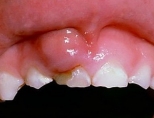 Опухла десна около зуба: что делать? Причины и лечение