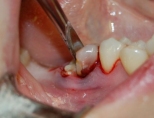 Удалили зуб, что делать после удаления?