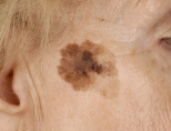 Как убрать коричневые пятна на лице: причины появление и лечение?