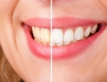 Как отбелить зубы активированным углем?