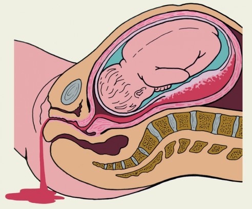Гематома в матке при беременности: диагностика, причины, лечение