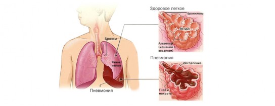 Лечение бронхита