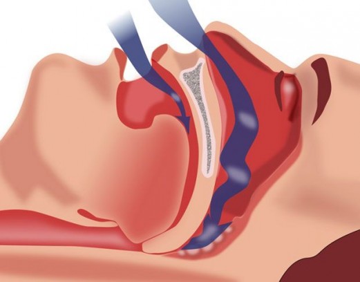 Причины появления храпа