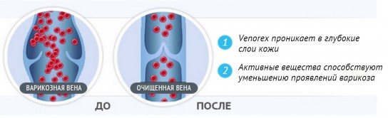 Разновидности мазей против варикоза