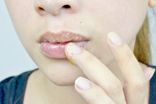 Эффективные методы по устранению трещин на губах