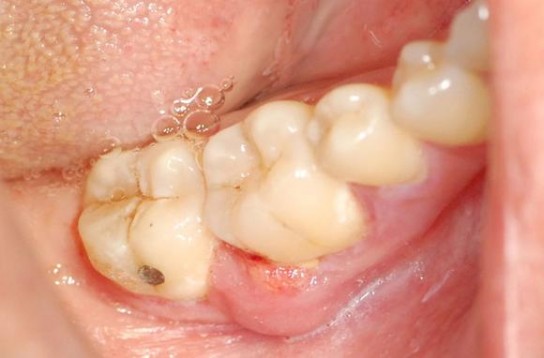 Причины появления опухоли около зуба