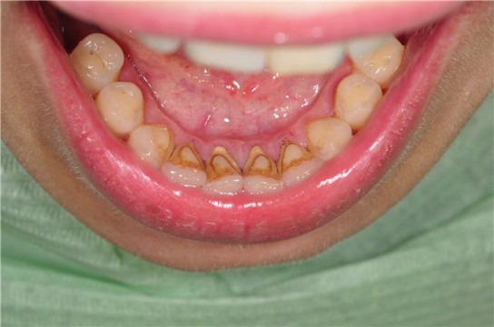 Другие причины появления опухоли около зуба