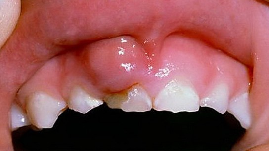 Опухла десна около зуба: что делать? Причины и лечение