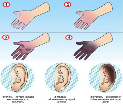 Степени обморожения рук