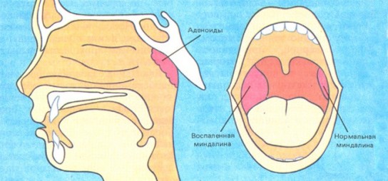 Болят гланды: что делать? Как лечить?