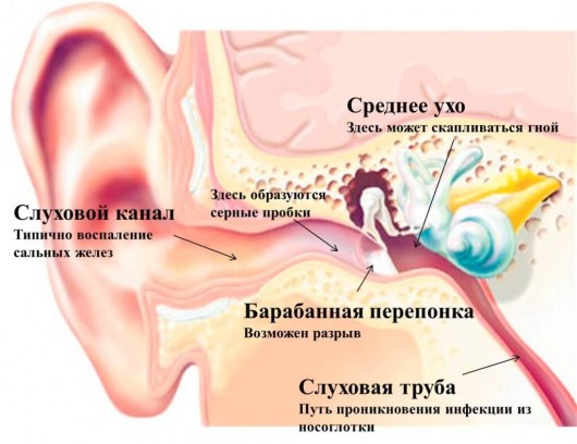 Что делать, если в ухо попала вода?