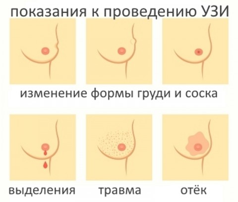 Процесс УЗИ молочной железы?